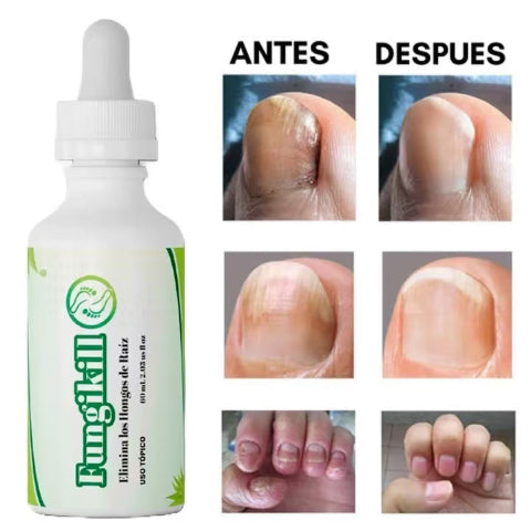FUNGIKILL ELIMINA LOS HONGOS